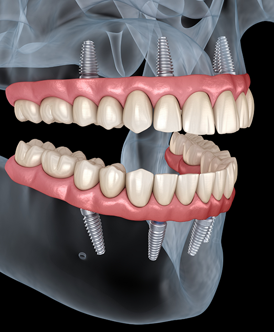 Hand holding a model of All on 4 dental implants in San Jose
