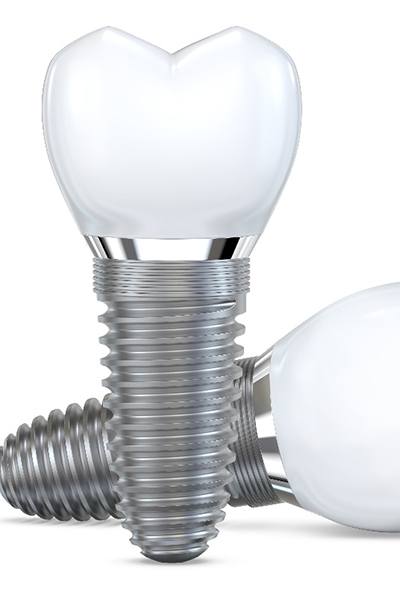 Illustration of two dental implants with crowns