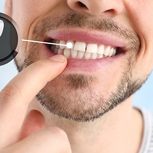 Man pointing to dental implant in mouth