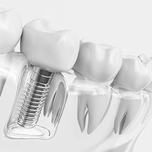 Illustration of dental implant in plastic model of mouth