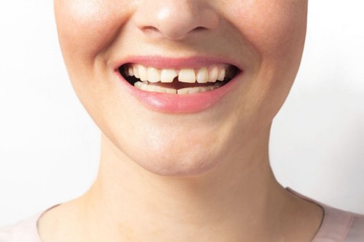 A woman with a broken tooth near Santa Clara