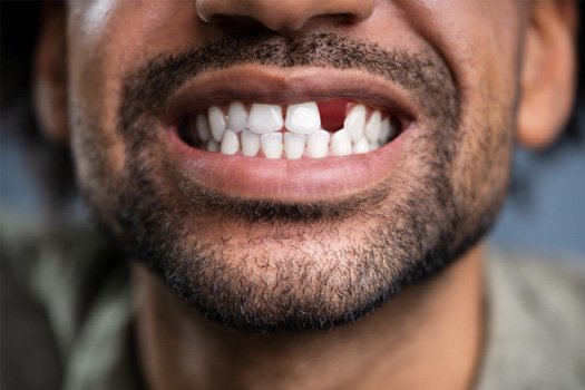 A man with a missing tooth near Santa Clara