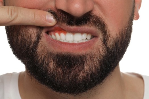 A man with red gums near Santa Clara