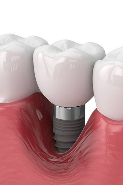 Illustration of a failed dental implant in San Jose