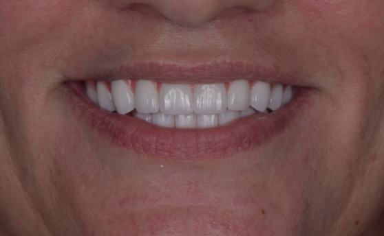 Dental patient smiling with a full row of flawless replacement teeth