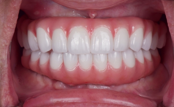 Dental patient smiling with a full row of flawless replacement teeth