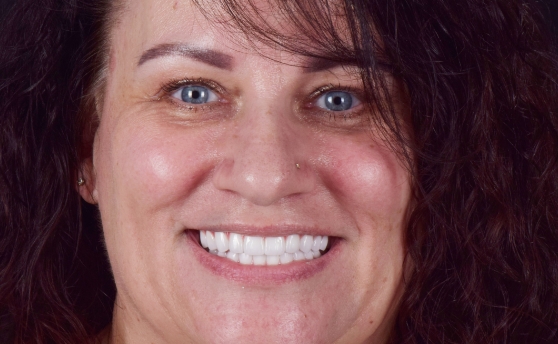 Dental patient smiling with a full row of flawless replacement teeth