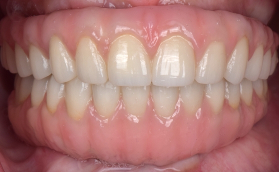 Dental patient smiling with a full row of flawless replacement teeth