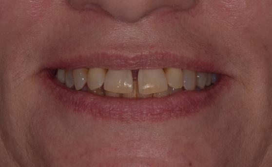 Dental patient smiling with damaged teeth