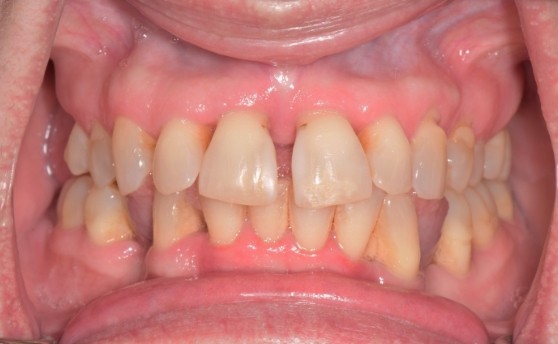Dental patient smiling with damaged teeth