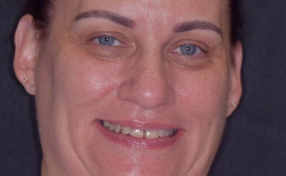 Dental patient smiling with damaged teeth