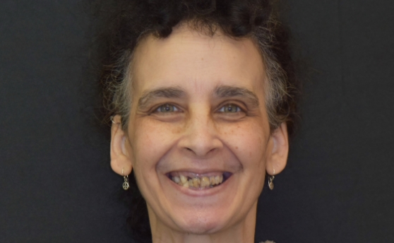 Dental patient smiling with damaged teeth