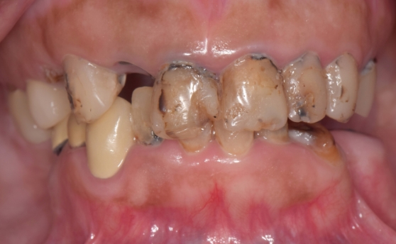 Dental patient smiling with damaged teeth