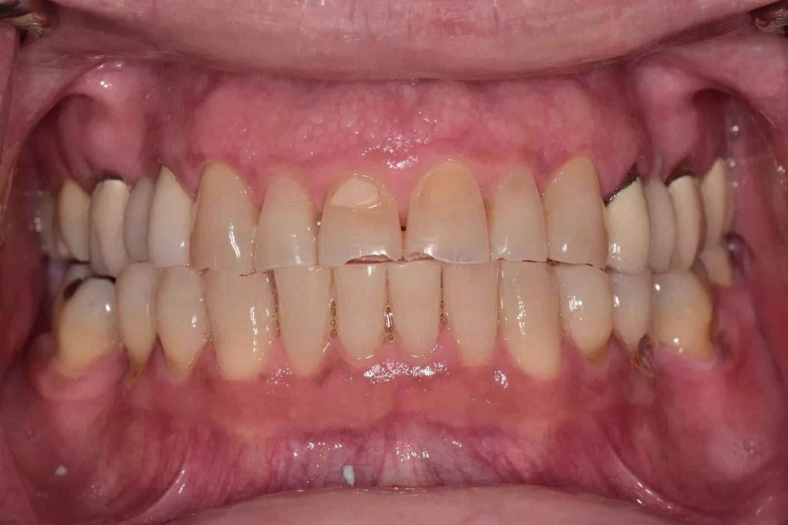 Man smiling with yellowed lower teeth