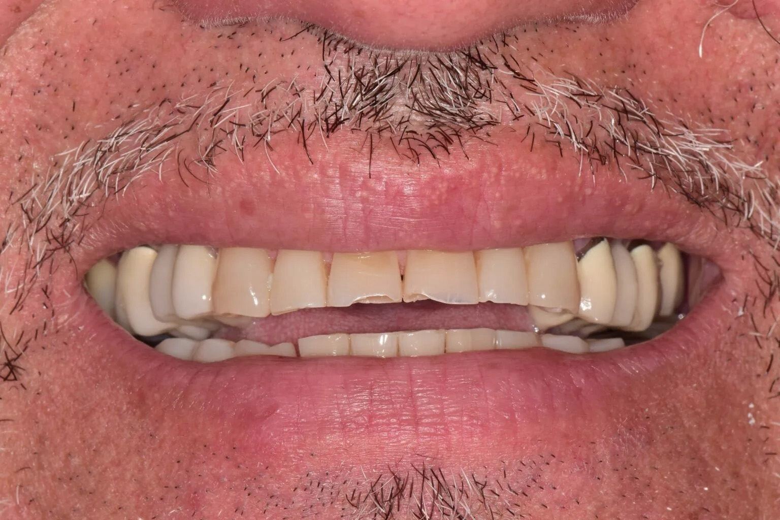 Smile with chipped and discolored teeth