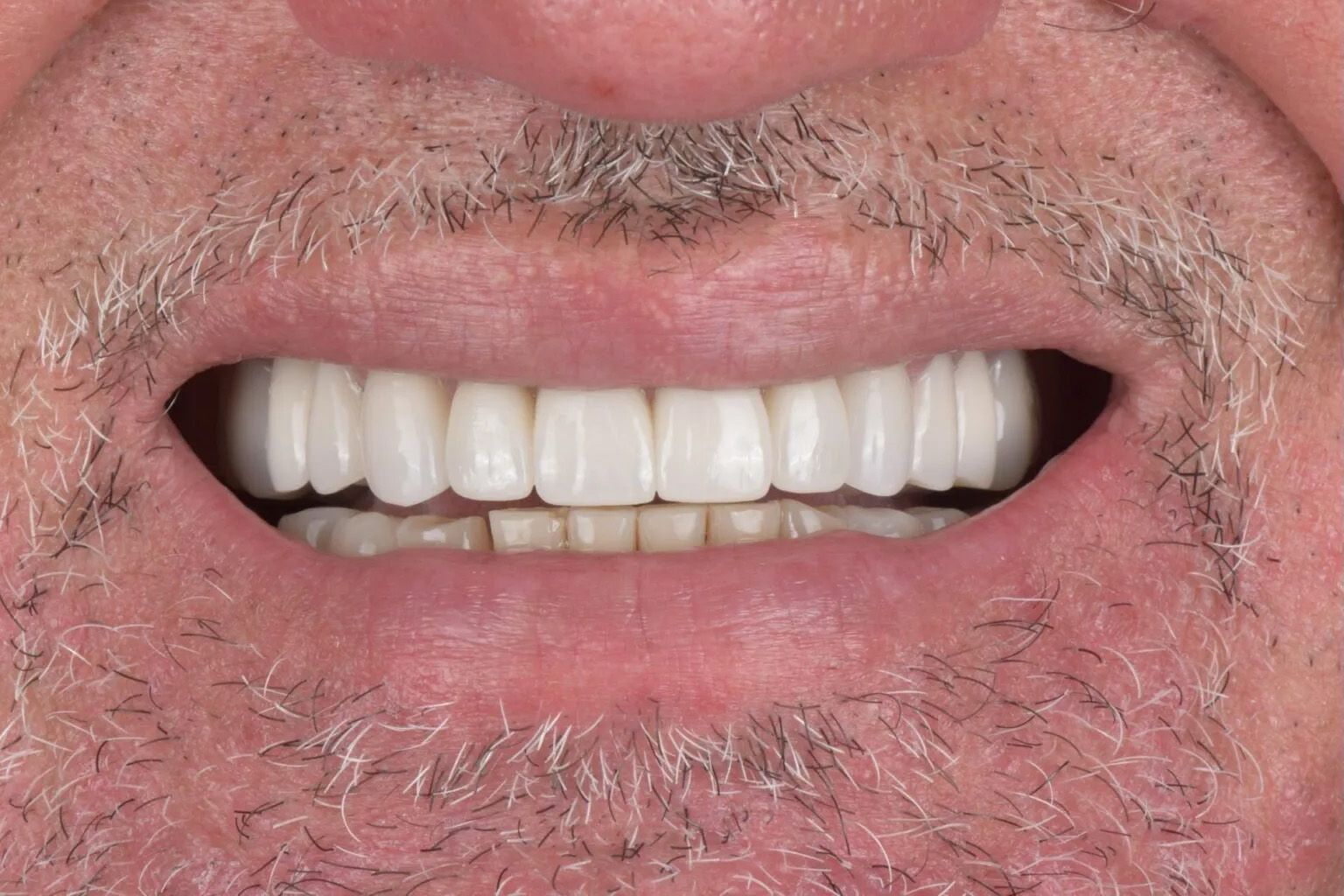 Smile after treating chipped and discolored teeth
