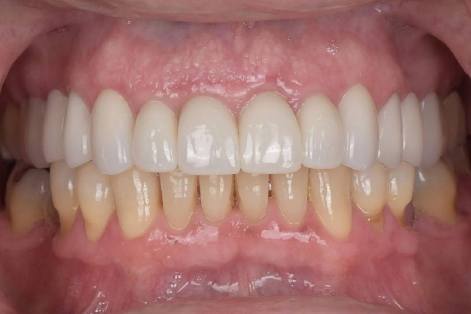 Man smiling with whiter lower teeth