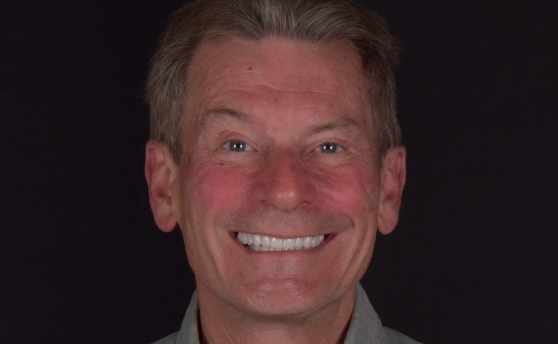 Close up of mouth with restored white teeth