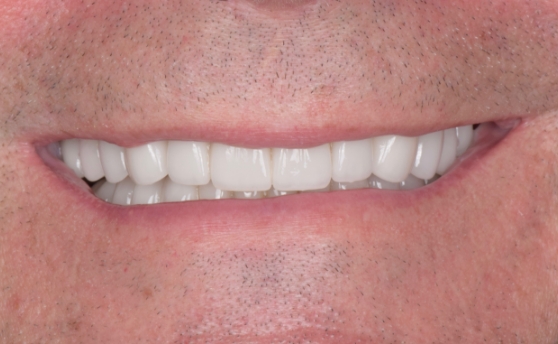 Close up of mouth with restored white teeth