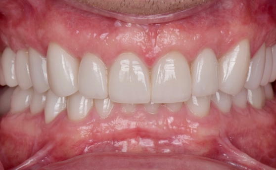 Close up of mouth with restored white teeth