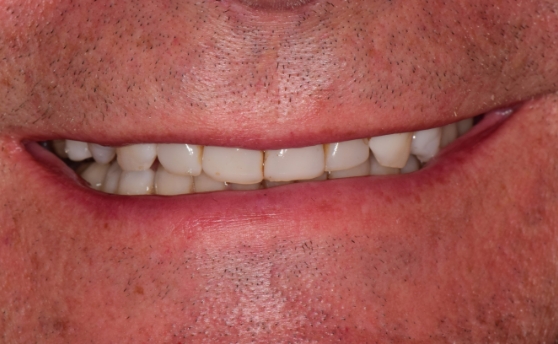 Close up of mouth with yellowed and slightly damaged teeth