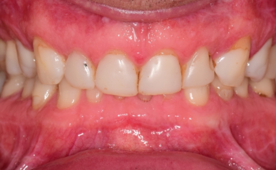 Close up of mouth with yellowed and slightly damaged teeth