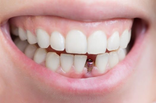 Close up of patient smiling to reveal a dental implant post