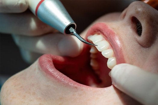 Close up of dentist using a dental laser to treat patient’s gum disease
