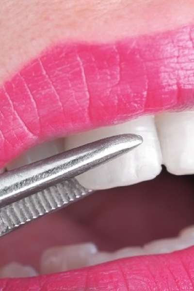 Close up of veneer being placed over a tooth