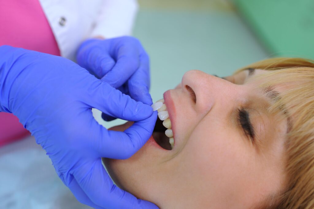 Dentist placing veneers on woman's teeth