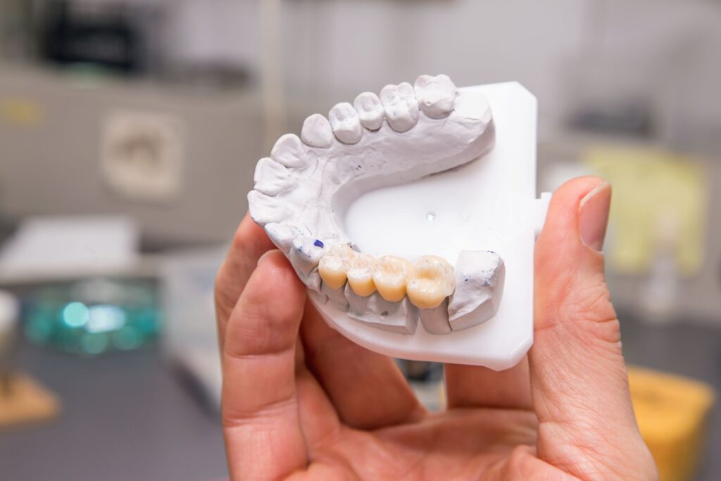 Hand holding model teeth with dental bridge attached