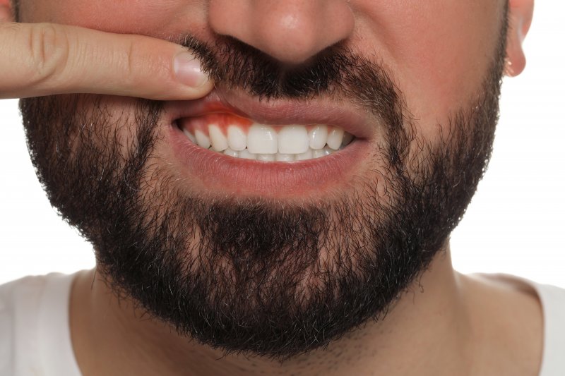 A bearded man revealing his swollen and inflamed gums