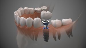 Digital image of a single dental implant