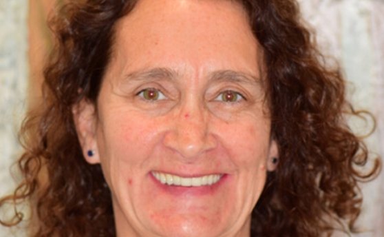 After photo of perfectly straight, white teeth