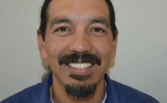 After photo of perfectly straight, white teeth
