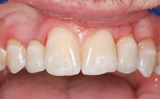 After photo of perfectly straight, white teeth