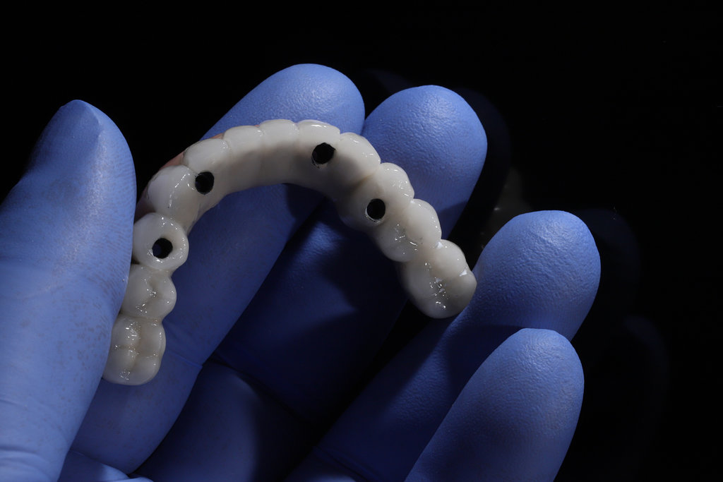 The All-on-4, All-on-X, and All-on-4 treatment concepts in dental implant therapy provide full arch dental prosthesis for completely edentulous jaws. Dental implants are a dentistry treatment placed