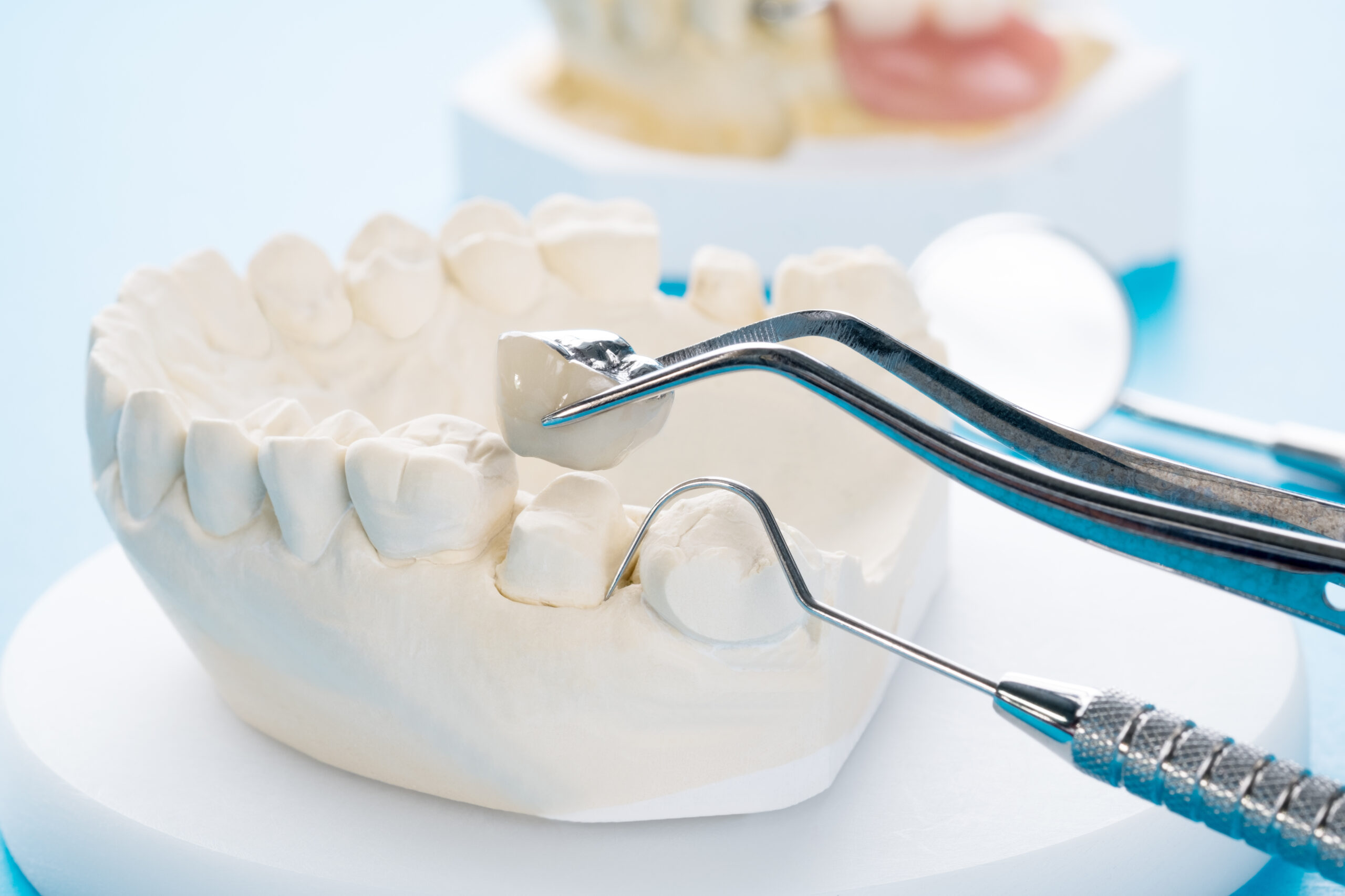 Close up implant and prosthodontic model.