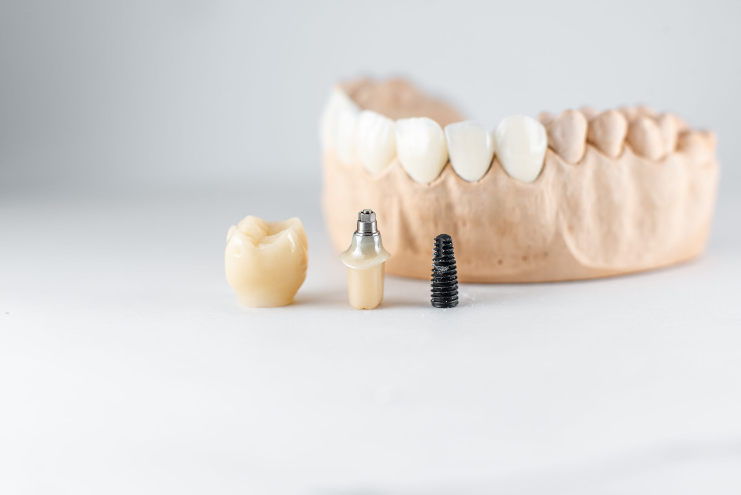 Close-up on plaster model of artificial jaw and dental implant on the white background. Concept of prosthetics and implantation in dentistry