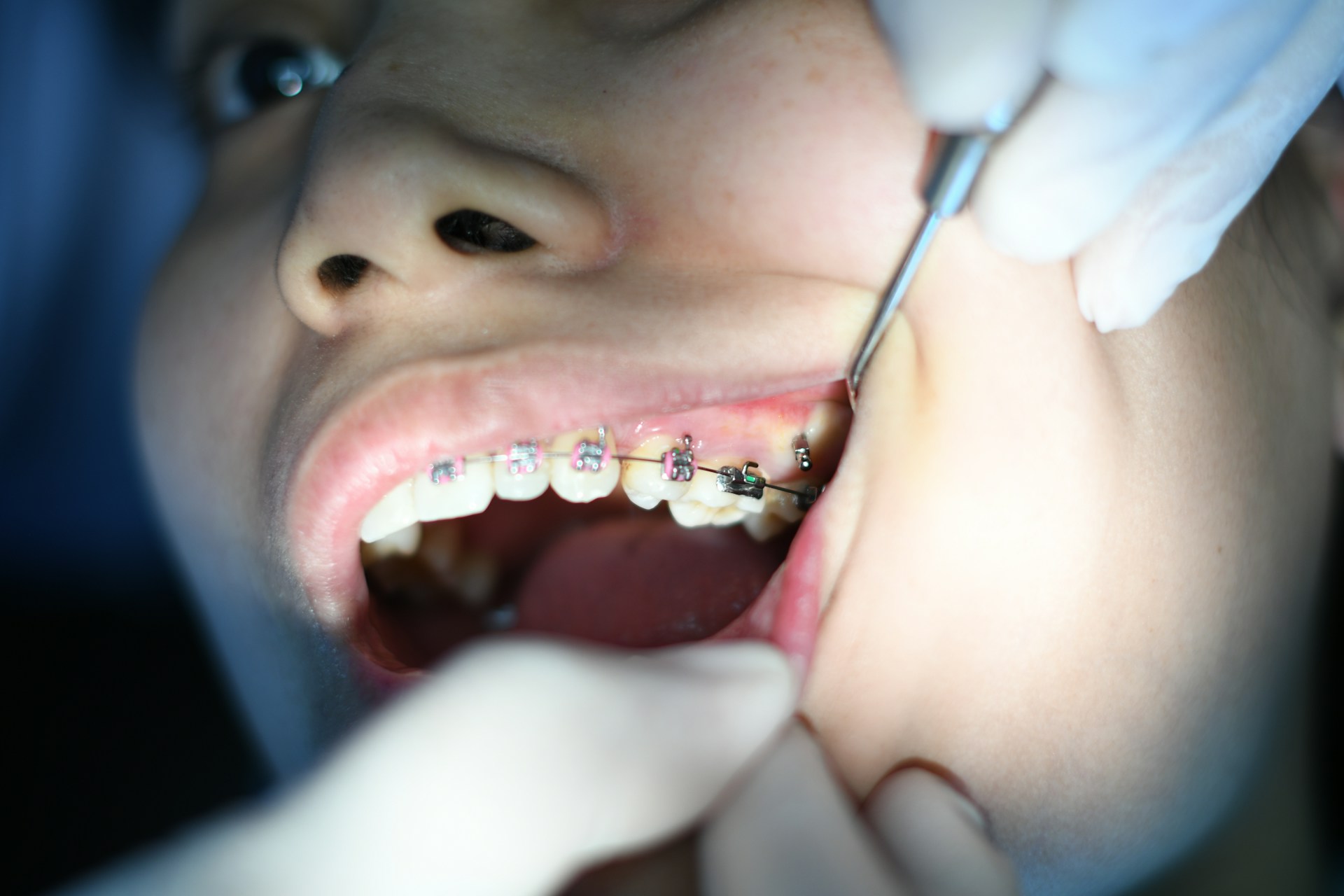 Person with silver teeth braces photo